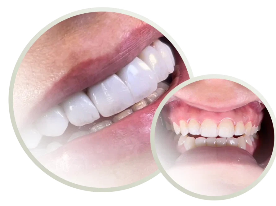 Comparação em close-up de duas bocas - uma com facetas dentárias criando dentes brilhantes e retos e a outra mostrando dentes naturais com gengivas mais visíveis.
