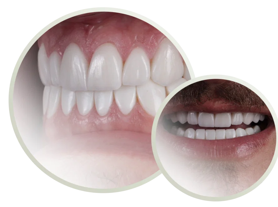 Imagens em close-up mostrando dois conjuntos de dentes retos e brancos com gengivas saudáveis, ambos parcialmente emoldurados por bordas circulares - resultados perfeitos das facetas dentárias de um dentista em Goiânia.