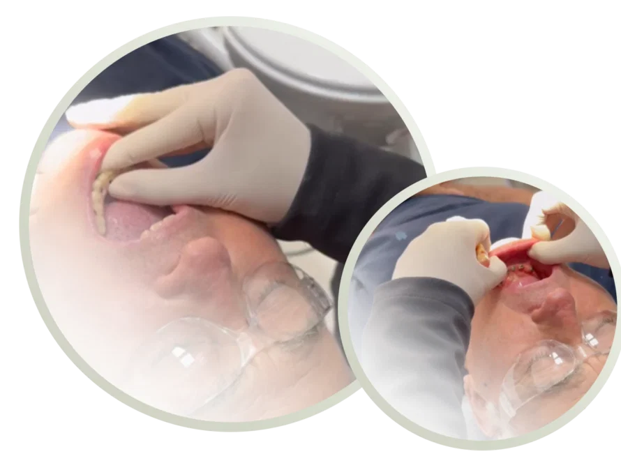 Uma pessoa que usa óculos recebe um exame odontológico; mãos com luvas inspecionam o interior da boca, possivelmente avaliando se há lentes de contato dentário ou facetas dentárias.